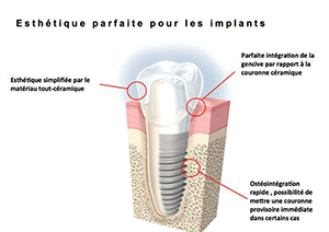Chirurgie pré-implantaire à Paris 15