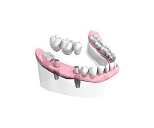 Remplacer plusieurs dents absentes ou abîmées - Dentiste Paris 15