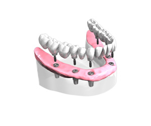 Remplacer toutes les dents absentes ou abîmées - Dentiste Paris 15