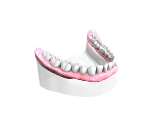 Remplacer plusieurs dents absentes ou abîmées - Dentiste Paris 15